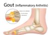 bigstock Gout inflammatory Arthritis 274922803 1 scaled