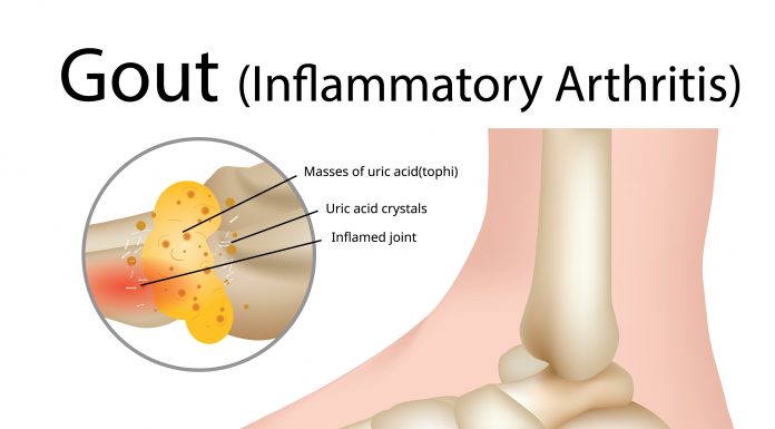 bigstock Gout inflammatory Arthritis 274922803 1 scaled