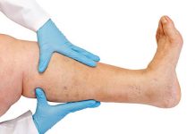 Varicose Veins