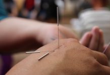 Dry Needling